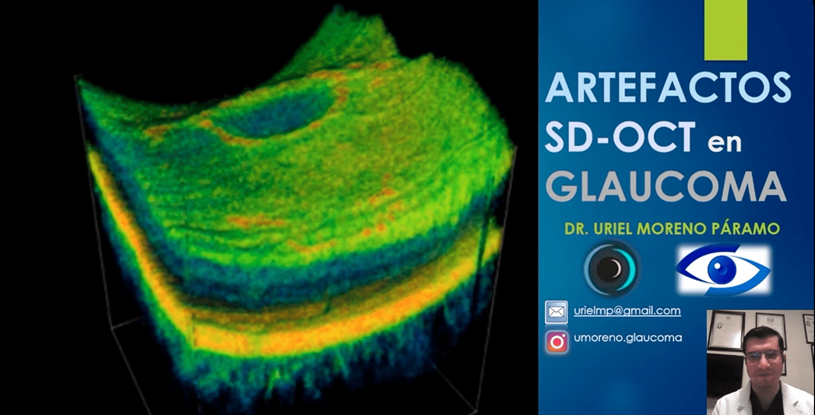 Artefactos SD-OCT en Glaucoma