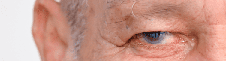 Coocurrencia de la enfermedad renal crónica y el glaucoma