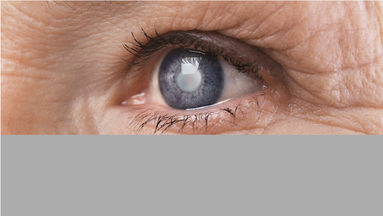 Cirugía de cataratas en pacientes con riesgo deprogresión a degeneración macular
