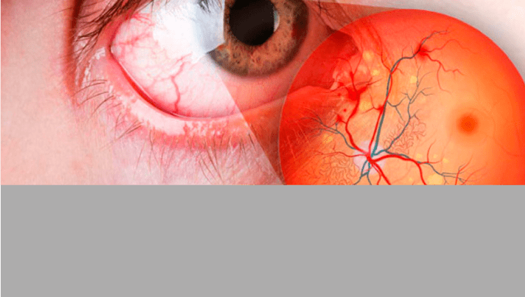 El futuro de la retinopatía diabética
