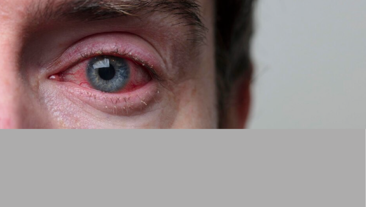 Actualización en cirugía refractiva y ojo seco.