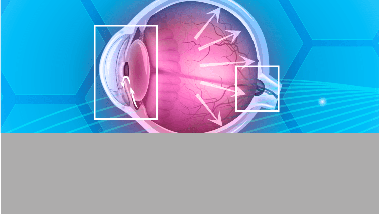 Integencia artificial: visión global en el manejo del glaucoma