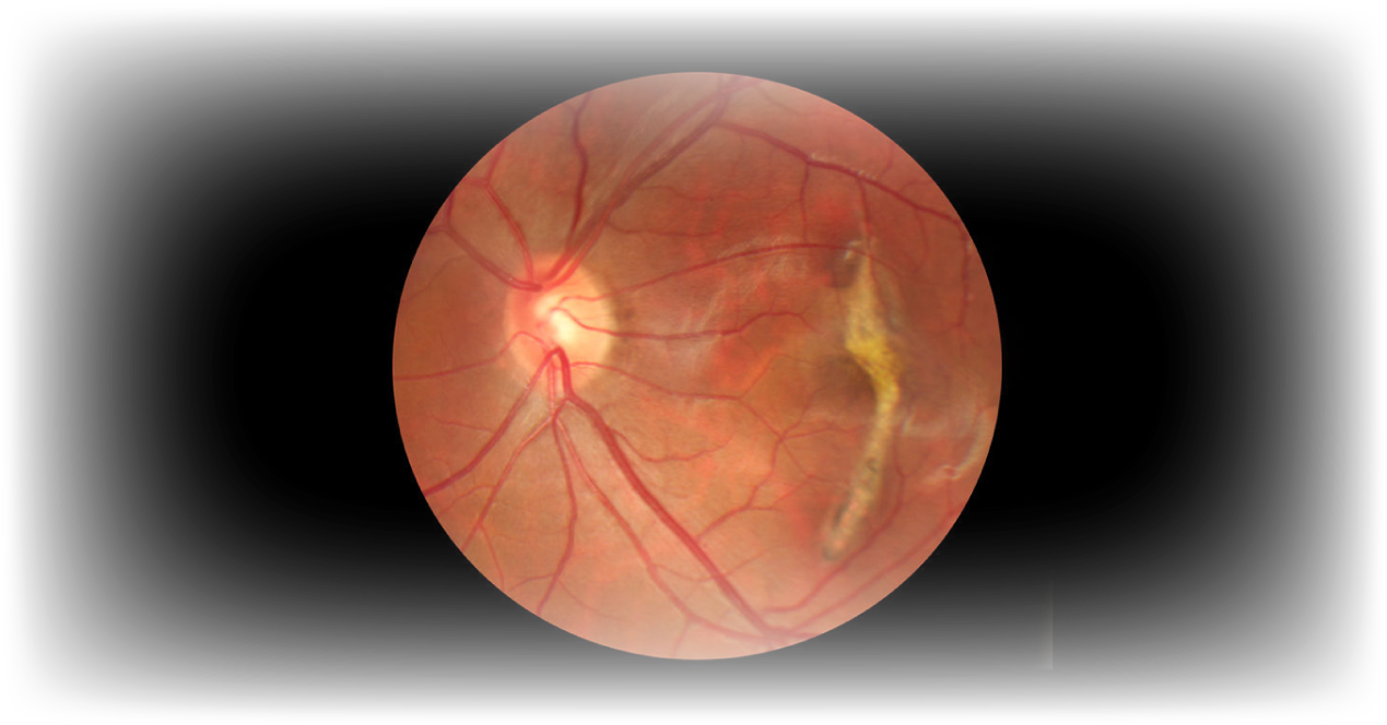 ¿Degeneración macular o degeneración retiniana?