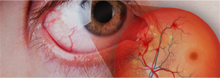 ¿La deficiencia de magnesio predice el riesgo de retinopatía diabética?