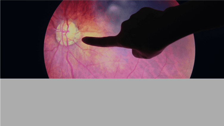 Cuantificación de factores de riesgo para la progresión de la retinopatía diabética
