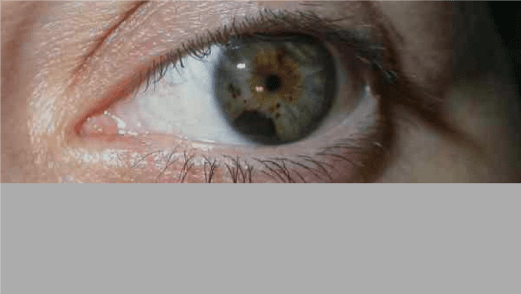 Melanoma coroideo: con motivo de la lucha contra el cáncer