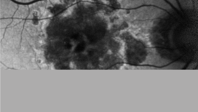 El papel de la inflamación en la degeneración macular relacionada con la edad: terapéutica en la atrofia geográfica