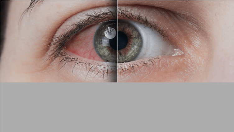 Enfermedad del ojo seco causada por infecciones virales