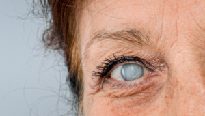 Imagen destacada de una nota sobre Salud Visual: Las cataratas en el blog de Laboratorios Grin
