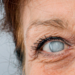 Imagen destacada de una nota sobre Salud Visual: Las cataratas en el blog de Laboratorios Grin