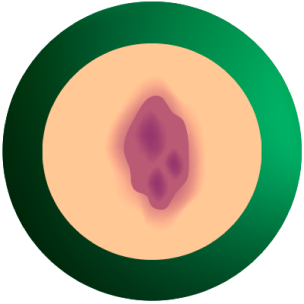 Elemento gráfico señales hematomas, mancha púrpura y decoloración de la piel
