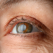 Elemento gráfico nota ¿cuántos tipos de glaucoma hay?