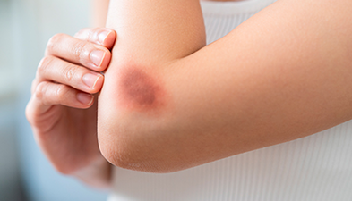 Causas de un hematoma