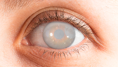 ¿Sabías que? | Glaucoma